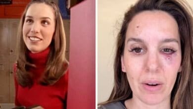 Split Image: Christy Carlson Romano in Even Stevens and showing off her facial injury.